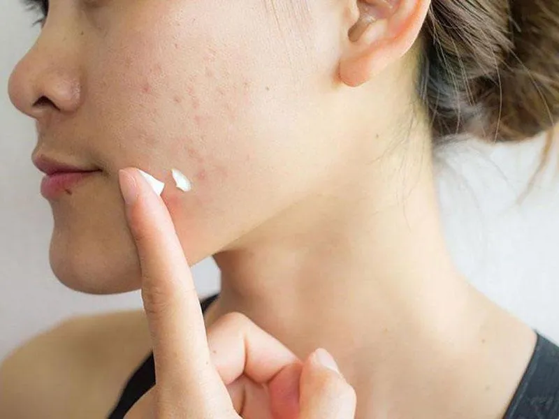Sử dụng thuốc điều trị mụn theo chỉ dẫn của bác sĩ